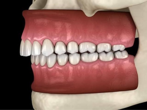 Rủi ro và những điều cần biết khi niềng