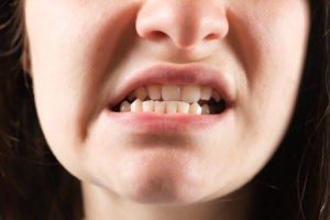 Khớp cắn ngược ảnh hưởng gương mặt, nhai, phát âm