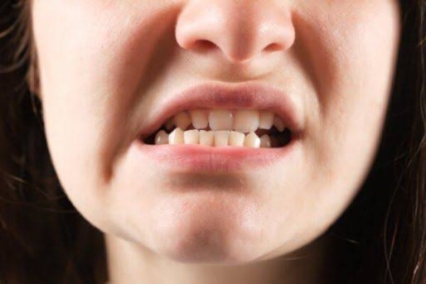 Khớp cắn ngược ảnh hưởng gương mặt, nhai, phát âm