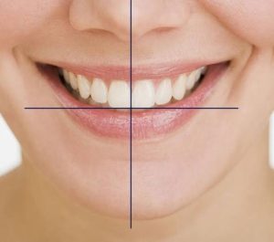 Khớp cắn hở ảnh hưởng thẩm mỹ, nhai, phát âm ra sao