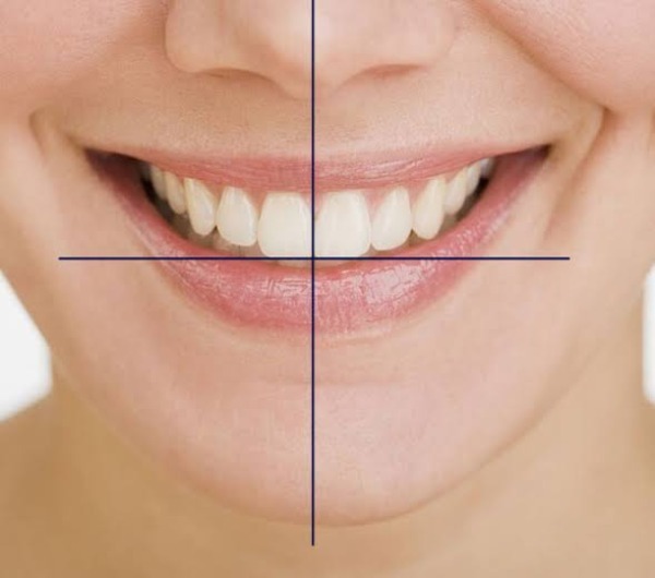 Tại sao khớp cắn lệch cần được chỉnh sửa?