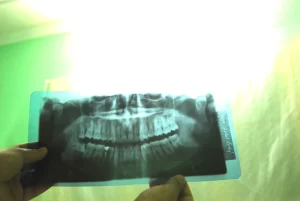 tooth extraction pain