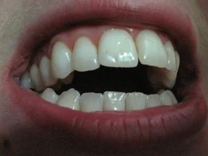 open bite dental anterior malocclusion