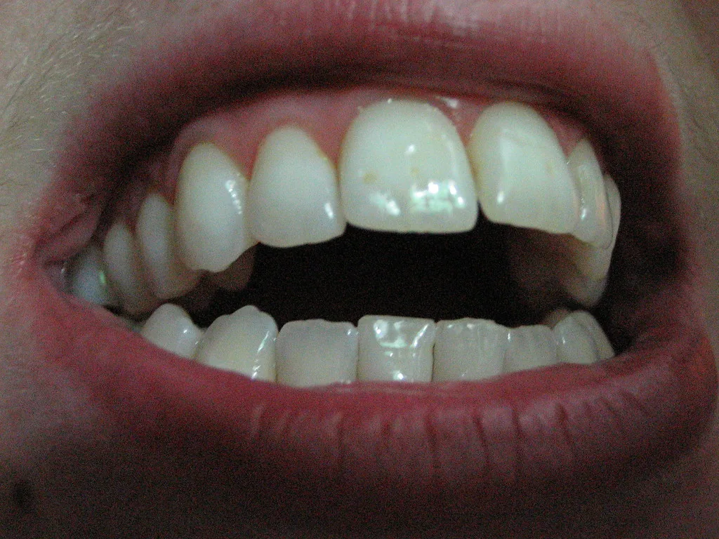 open bite dental anterior malocclusion