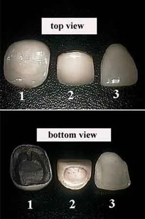 Các loại sứ và giá tương ứng là gì?