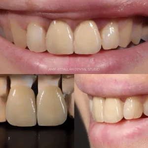 porcelain crown bad breath causes