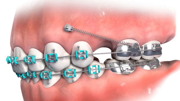 Cách giảm đau hiệu quả sau cắm minivis