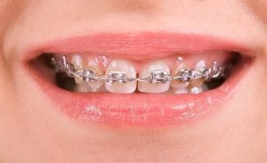 Nên niềng trước hay implant trước