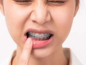 Dấu hiệu cảnh báo tụt lợi khi niềng là gì?