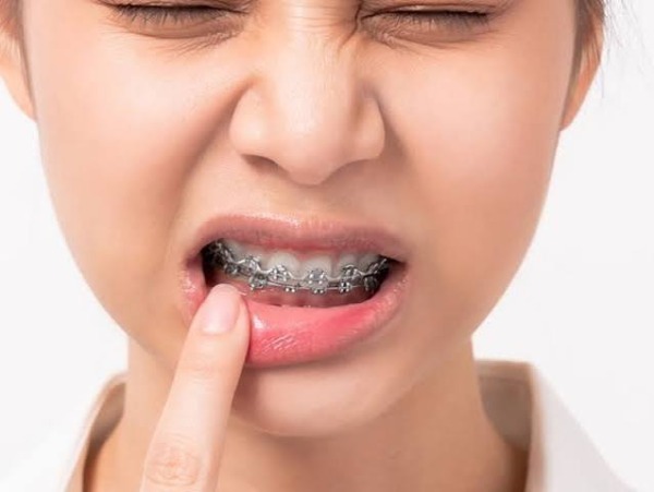 Dấu hiệu cảnh báo tụt lợi khi niềng là gì?