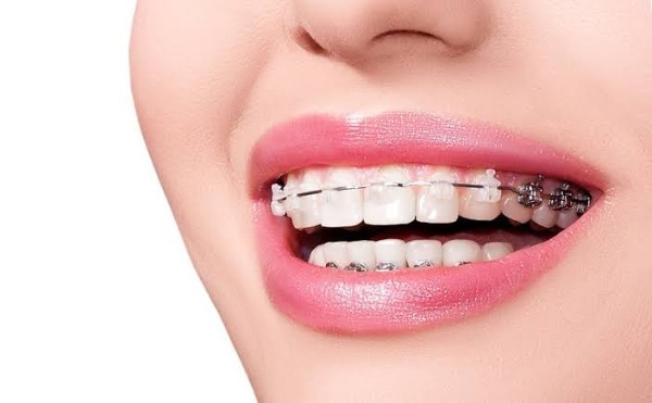 Niềng răng có thay đổi khuôn mặt không?
