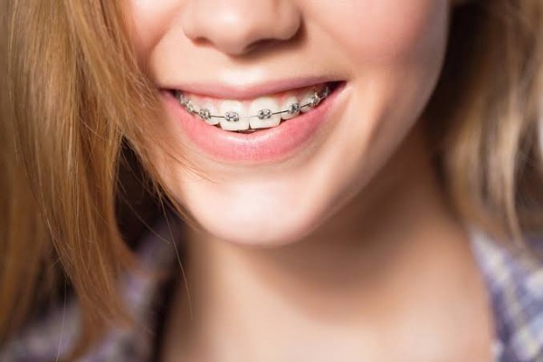 5 yếu tố khác ảnh hưởng thời gian niềng