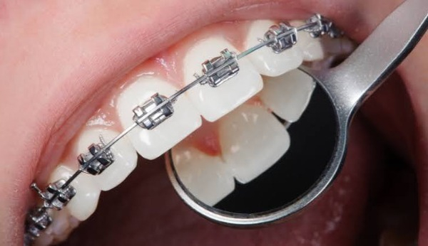 Implant và niềng răng hoạt động khác nhau thế nào?