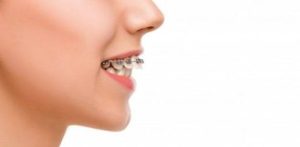 Khớp cắn chìa là gì? Định nghĩa và cách điều trị