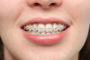 Răng bị xô lệch sau niềng: Nguyên nhân và cách duy trì hiệu quả