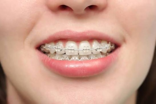 Răng bị xô lệch sau niềng: Nguyên nhân và cách duy trì hiệu quả