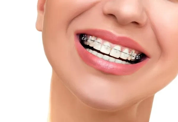 Giá bọc răng sứ Emax hiện nay: Bảng giá chi tiết 2026