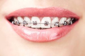 Cần chăm sóc như thế nào khi niềng răng lúc mang thai?