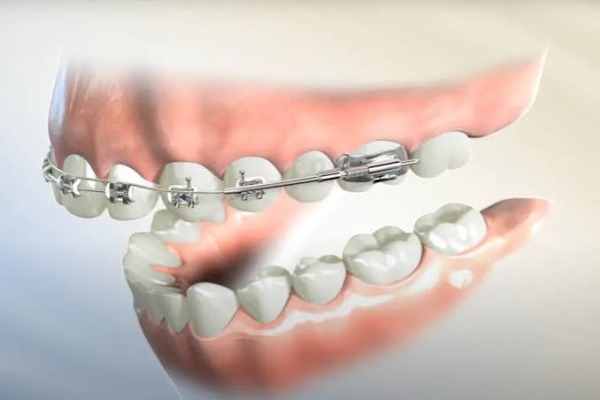 Niềng răng 1 hàm là gì và khi nào được chỉ định?
