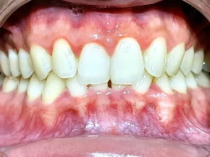 Không điều trị khớp cắn sâu gây tác hại gì?