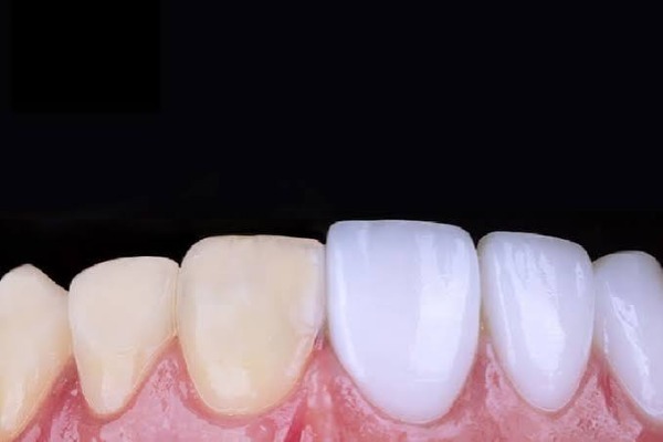 Veneer sứ hoạt động như thế nào?