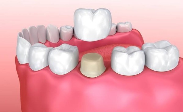 Cách xử lý khi cần chụp MRI với bọc sứ kim loại