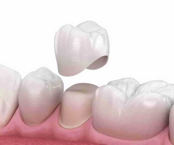 Tại sao giai đoạn sau bọc sứ cần kiêng ăn uống?