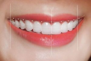 Khớp cắn chìa có những dấu hiệu gì và gây hại thế nào?