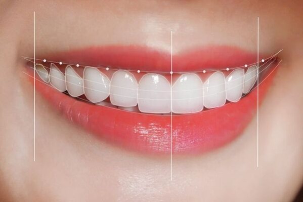 Khớp cắn chìa có những dấu hiệu gì và gây hại thế nào?