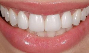 Bọc sứ có bị hở kẽ: Nguyên nhân, dấu hiệu, cách xử lý