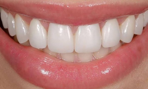 Bọc sứ có bị hở kẽ: Nguyên nhân, dấu hiệu, cách xử lý