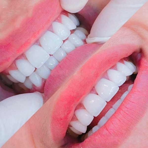 Tại sao bọc sứ kim loại dễ bị đen viền nướu?