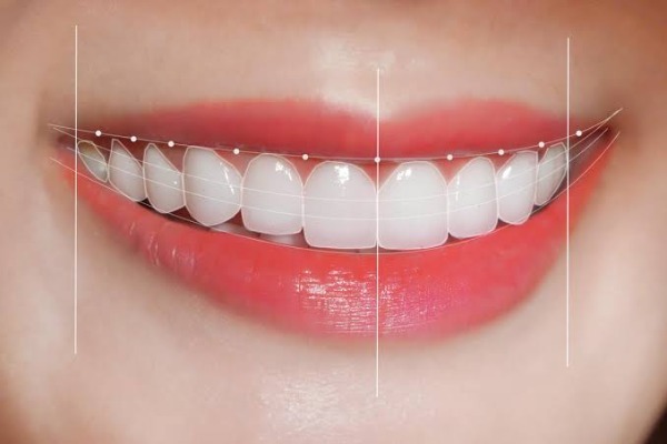 Làm thế nào để chăm sóc veneer sứ bền lâu?