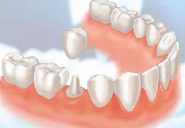 Những hiểu lầm phổ biến nào về bọc sứ