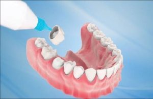 Bọc răng sứ kim loại có bị đen viền nướu không? Nguyên nhân và cách phòng tránh