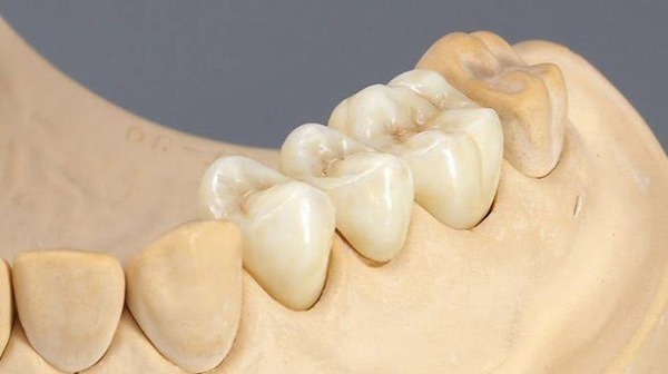 Bọc sứ có phải mài nhiều không?