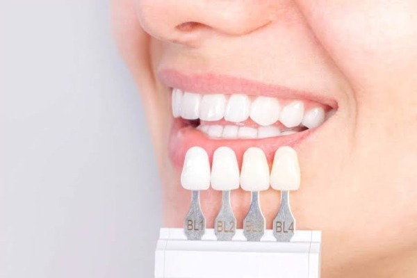 Dán sứ veneer có bền không? Tuổi thọ và cách chăm sóc