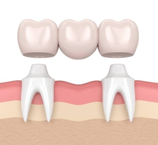 Răng cấm là gì và vì sao chúng dễ bị hư hỏng?