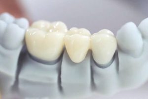 Yếu tố nào ảnh hưởng đến giá bọc sứ?