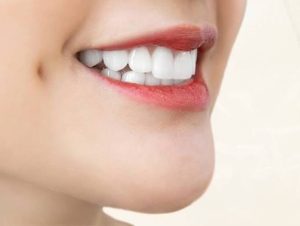 Bọc răng sứ có hôn được không? Câu trả lời từ nha sĩ