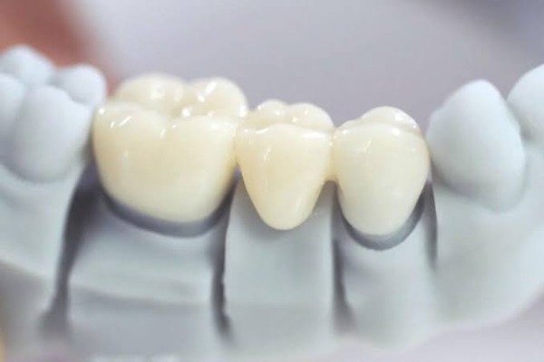 Bọc răng sứ giữ được bao lâu?