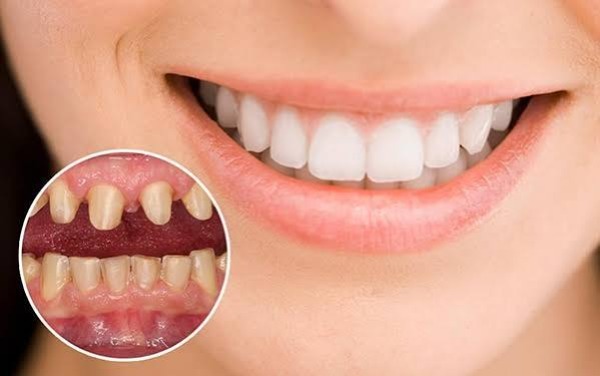 Bọc sứ là gì và tại sao cần biết về hôn?