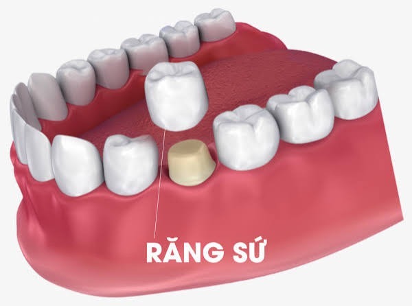 Bọc răng sứ có bị mòn không? Nguyên nhân và cách bảo vệ