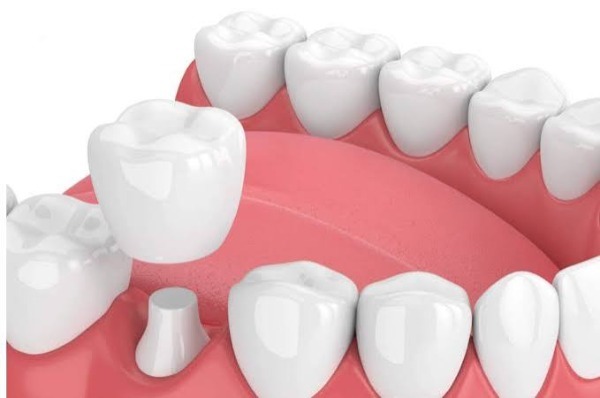 Tại sao bọc răng sứ có thể bị mòn?