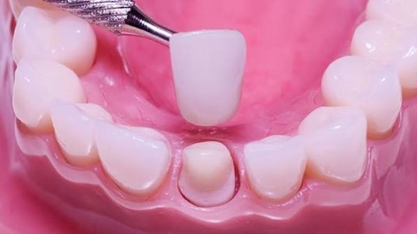 Zirconia có bị đen viền nướu như titan không?
