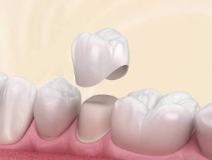 Tại sao bọc sứ lại gây viêm lợi?