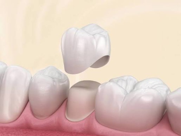Tại sao bọc sứ lại gây viêm lợi?