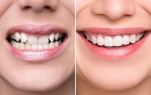 Cách chữa viêm lợi sau bọc sứ hiệu quả?