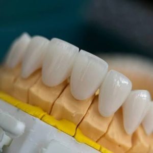 Bọc sứ bị viêm lợi phải làm sao? Hướng dẫn khắc phục