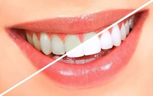 Bọc răng sứ bị tụt lợi: Nguyên nhân và cách xử trí